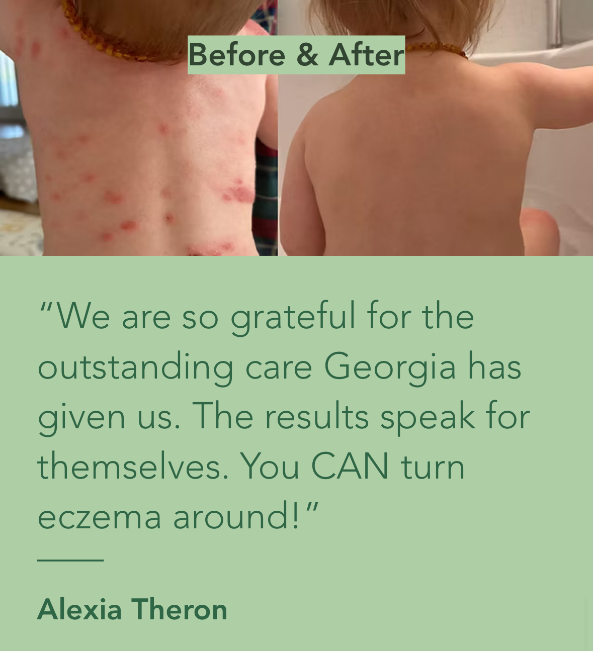 Before and after photos showing a child's back, with eczema flares cleared