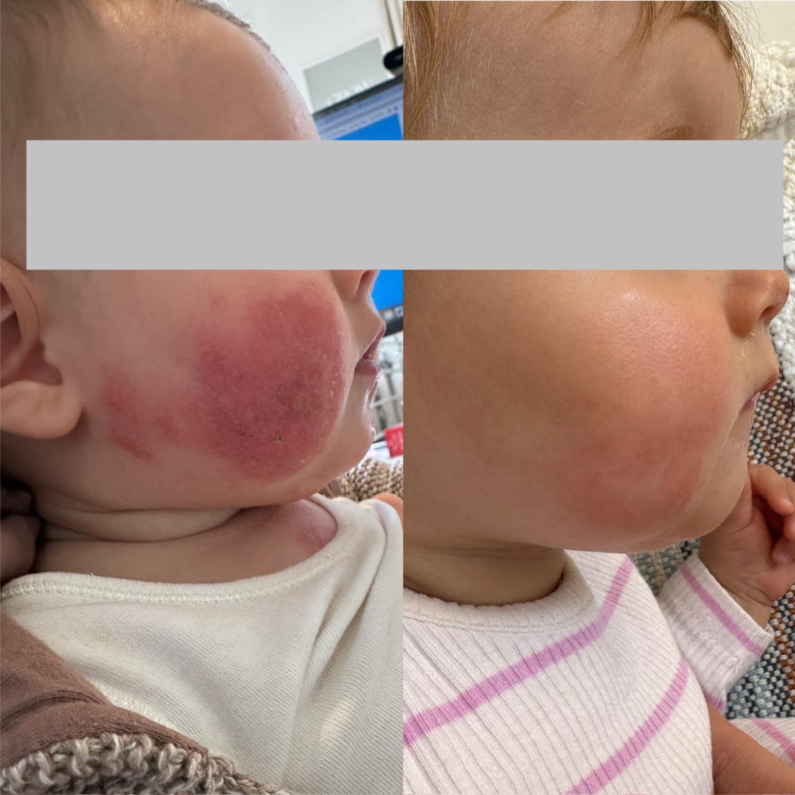 Before and after photos showing a baby's cheek, red and inflamed before, calm and clear after